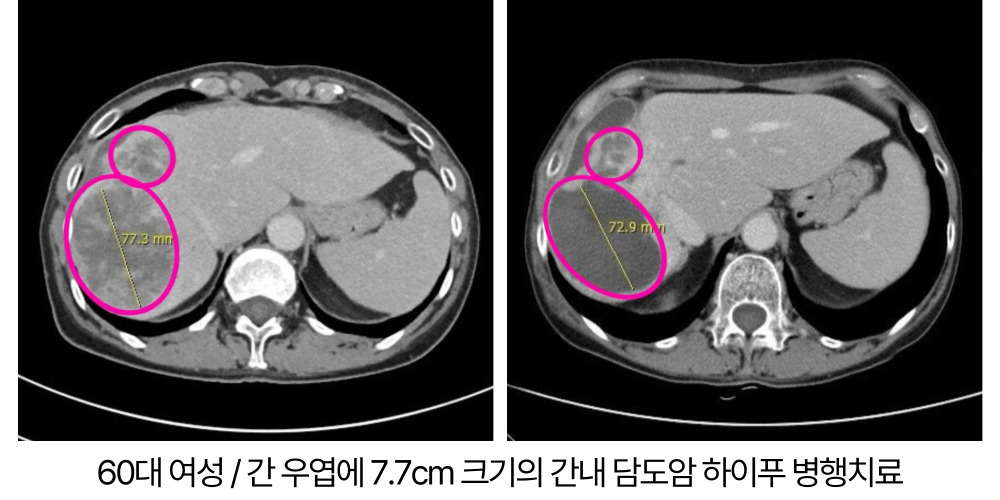 수술적 한계 직면한 담도암, 항암·하이푸 병행 치료 어떨까? - 세계일보